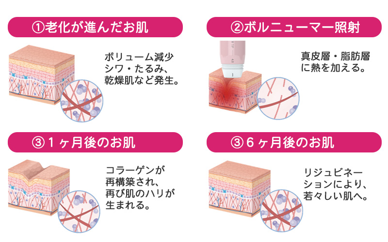ボルニューマー高周波RF