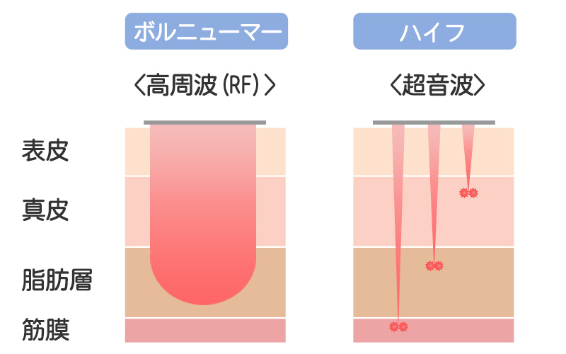 ボルニューマー高周波RF